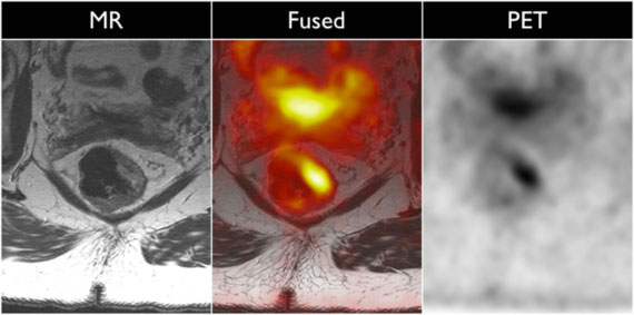 Figure 1: patient with newly diagnosed T2 rectal cancer. The mass is can be seen on MRI, but localization using PET imaging aids in localization. Additionally, the metabolic activity can be used to determine therapy response on serial imaging, and PET data can be used to detect distant metastasis.