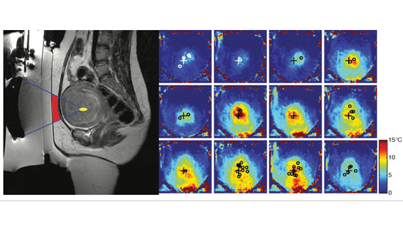 Temperature change from the baseline in the same patient. Intersections of the beam axes and the slice are shown as circles, location of the measurement as “cross”