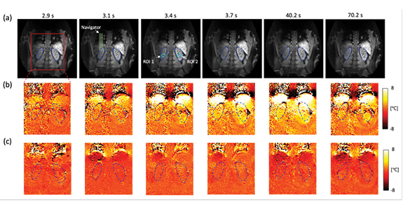 The result of healthy volunteer experiments without heating (volunteer #1). (a) A coronal slice is acquired and shows the left and right kidney organs which are indicated with blue dashed lines. PRFS temperature maps show that a (c) multi-baseline PRFS reconstruction allows stable and homogeneous temperature measurements, compared to a (b) single baseline