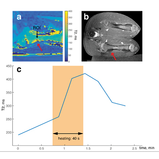 T2 measurement in vivo bone marrow: (a) T2 map during ablation of a single sonication, showing the ROI; (b) post-contrast 3D Fast SPGR image after ablation (total of six sonications per location); (c) plot of T2 values within the ROI over time; the highlighted area shows the approximate duration of the sonication.