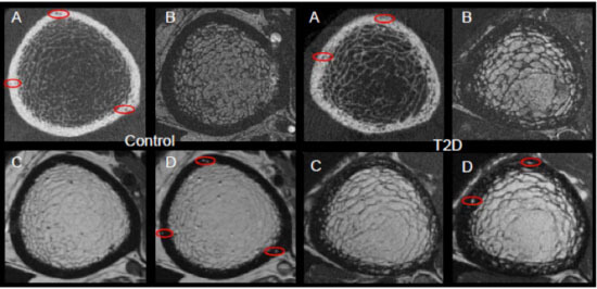 Progression and etiology of cortical porosity in diabetic bone disease