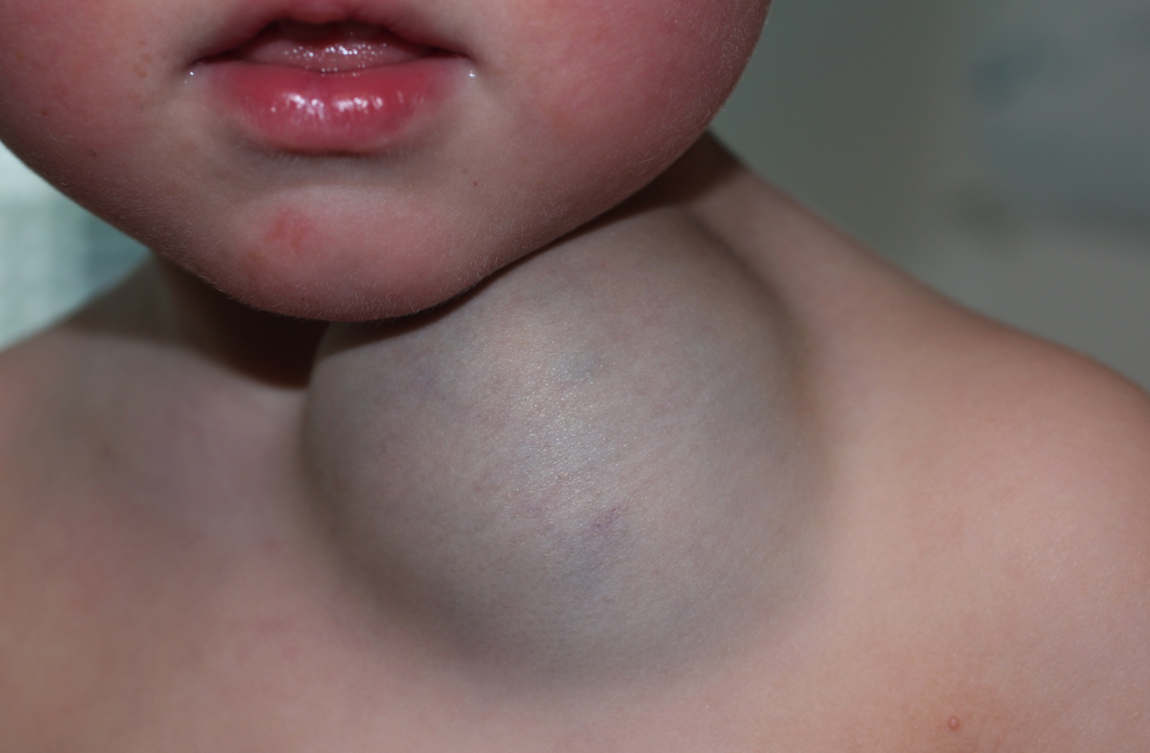 Vascular Birthmarks Guide: Causes, Symptoms and Treatment ...