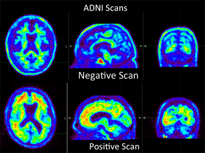 Amyvid™ Scan (Florbetapir) Amyloid Imaging For Alzheimer Disease ...