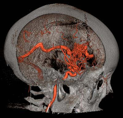 Brain Arteriovenous Malformations (AVMs)