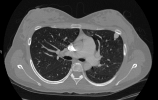 Chest CT PAVMs