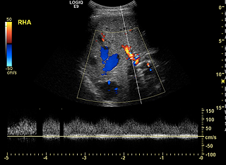Ultrasound Liver AVM
