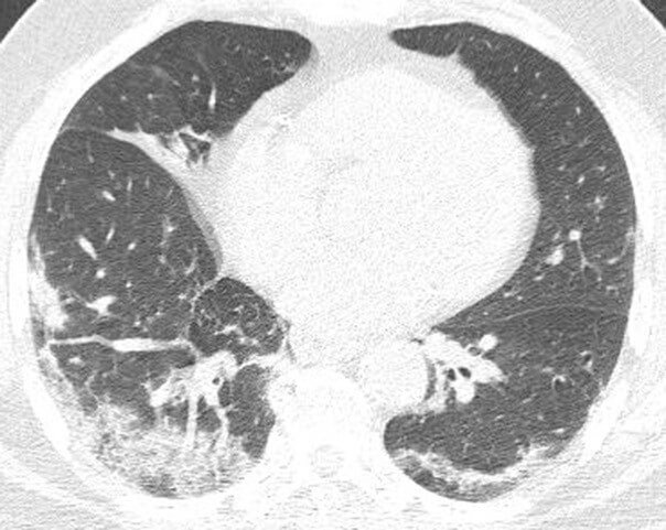 Typical appearance of COVID-19 infection on CT
