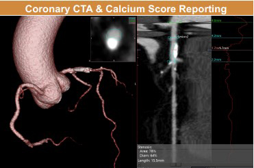 Medical image of coronary CTA and calcium score reporting 