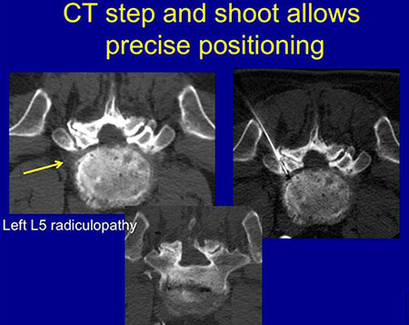 Arthrogram using CT step and shoot technique