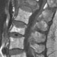 DXA image of spine