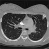 Chest CT, Pulmonary Arteriovenous Malformations (PAVMs)