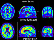 Amyloid PET scan for diagnosis