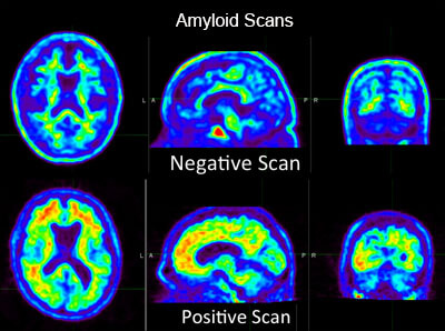 Amyloid Scan Showing Positive and Negative Alzheimer's Diagnosis