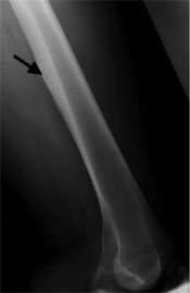 X-ray of Osteoid Osteoma