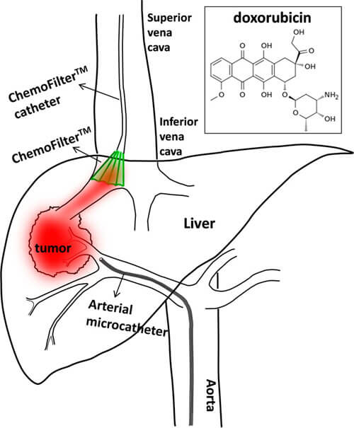 Schematic of the ChemoFilter Device That Incorporates a Block Copolymer Membrane That Captures Target Drugs In Situ