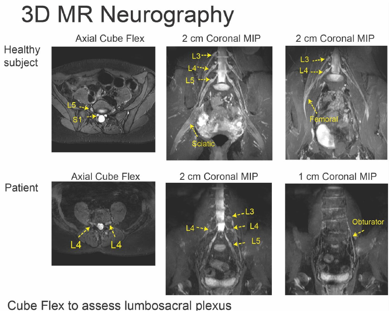 3D MR Neurography