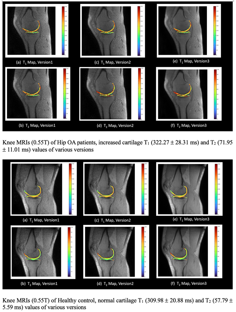 Diagram: Knee MRIs (0.55T) of Hip OA patients, increased cartilage T<sub>1</sub> (322.27 ±- 28.31 ms) and T<sub>2</sub> (71.95 ± ms) values of various versions.
