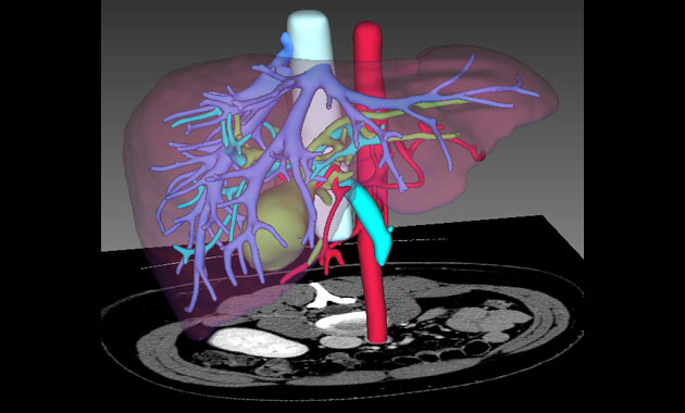 Liver Donor 3-dimensional CT evaluation of blood vessels bile ducts and liver volumes