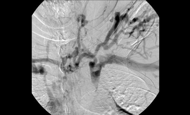 Thrombosis of the left brachiocephalic vein secondary to persistently elevated flow rates related to upper extremity AV fistula
