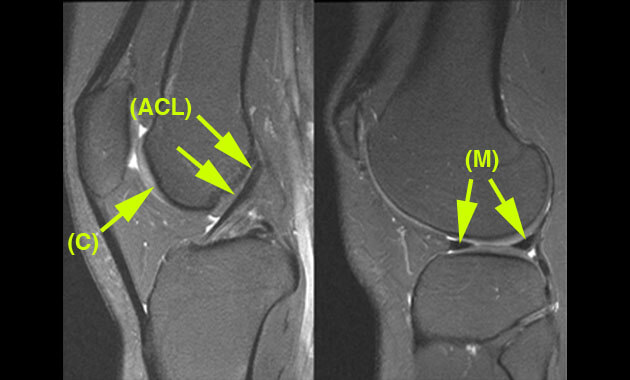 MR Images of knee cartilage, ACL, and menisci