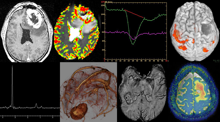 This collection of MR images of brain tumors shows high resolution anatomic images and advanced physiologic images that provide a comprehensive characterization of structural and biologic alteration related to brain tumors and surrounding brain.