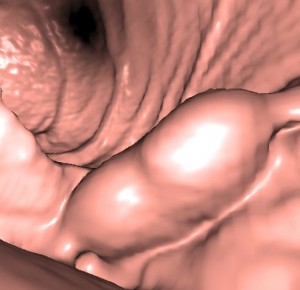 Three-dimensional virtual endoscopic CT reformation of the gastric tumor shows that it has two lobes and straddles a gastric fold.