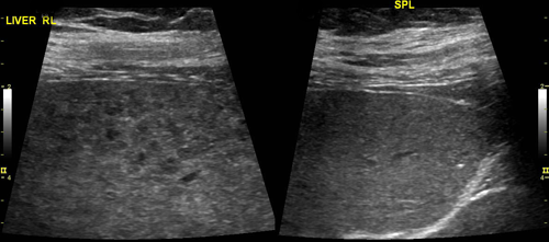 High resolution imaging of a nodular liver (left) is compared to a normal architecture of the spleen (right). High Resolution Imaging - UCSF Medical