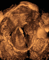 Malpositioned IUD - UCSF Medical