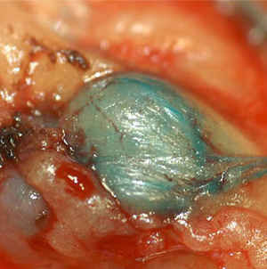 Metastatic Lymph Node - UCSF Medical