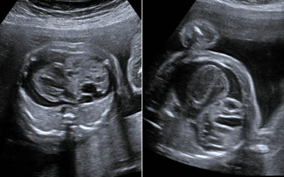 Abdominal Ultrasound - UCSF Medical