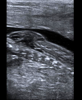 Fetal Treatment - UCSF Medical