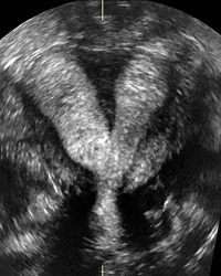 Separated Uterus 3D Image - UCSF Medical