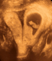 Separated Uterus Left Horn - UCSF Medical