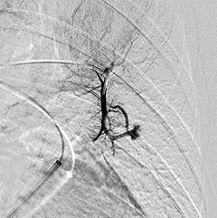 Pulmonary angiogram (PAVMs)