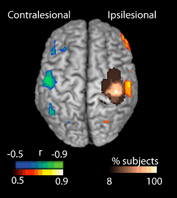 ischemic stroke