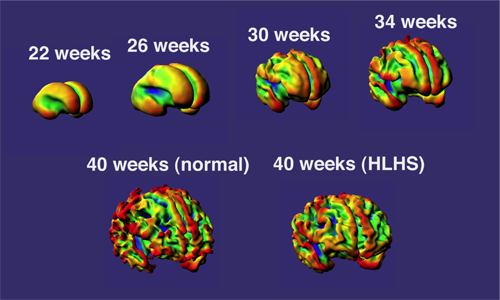Macroscopic brain development – cortical folding. Three-dimensional reconstructions of cortical white matter volumes from MRI scans taken at 24 weeks to term gestation showing the development of cortical folding and surface curvature. The white matter surface from a term newborn with hypoplastic left heart syndrome displays noticeably less cortical folding and smoother surface curvature than a term newborn without heart disease. Cardiac MRI baby brain study