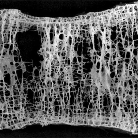 2004: Thomas Lang, PhD, and colleagues from UCSF and Baylor School of Medicine began work with NASA on bone loss in astronauts, research now applied to earthbound bones.