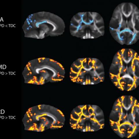 Pratik Mukherjee, MD, PhD, and his team’s groundbreaking work on Sensory Processing Disorder (SPD) published in Frontiers in Neuroanatomy, was the biggest imagng study ever done in children with the condition. His research promted a broad acknowledgement of SPD as a separate disorder from Autism.