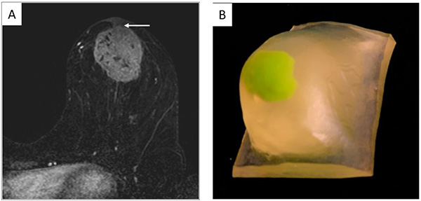(A) Axial contrast-enhanced MRI showing a left breast mass with direct invasion of the overlying nipple areolar complex (arrow). (B) A patient-specific 3D printed model generated from the MRI was used for patient education and obtaining of informed consent. 3D printed models allow patients to easily understand the extent of disease and rationale for a specific surgical approach.