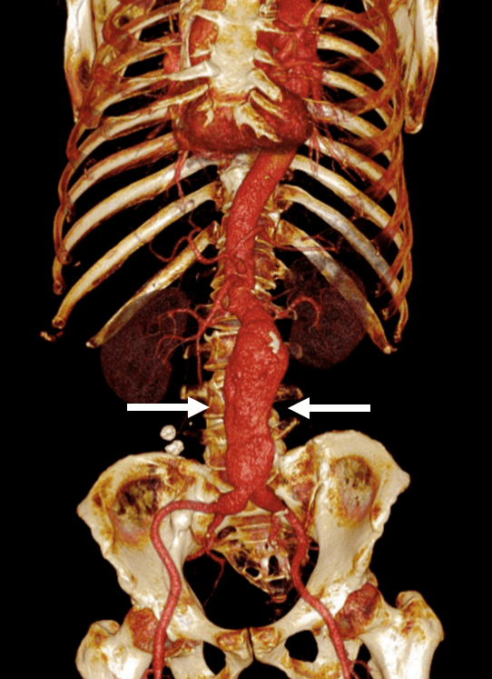 3D rendering of a CT angiogram on a black background