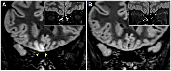 Coronal T2 FLAIR view of cortical hyperintensity in the right gyrus rectus (yellow arrowheads) and subtle hyperintensity/enlargement of the bilateral olfactory bulbs (inset, white arrowheads) of a 25-year-old woman with anosmia and PCR-confirmed SARS-CoV-2 infection; (b) 28 days later, the cortical hyperintensity is completely resolved with slight reductions in the intensity and thickness of the olfactory bulbs