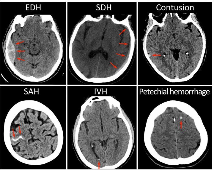 A series of CT scan images showing clues about concussion recovery provided by UCSF researchers