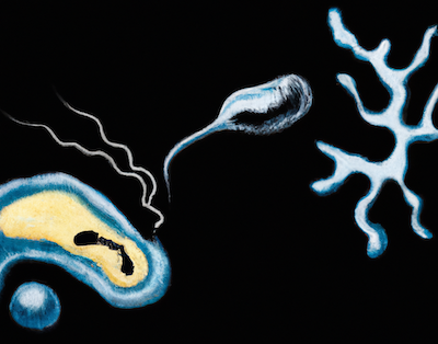 DALL-E AI-created image illustrating PD and alpha-synuclein pathology.