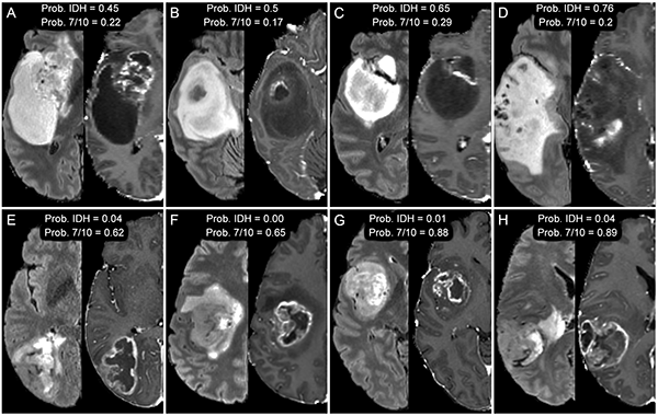 Axial MR images of glioblastomas from 8 different patients, IDH mutant (A–D) and chromosome 7/10 aneuploid (E–H). T2-weighted FLAIR images (left) are shown beside corresponding T1-weighted postcontrast images (right). Relative probabilities of IDH mutation (Prob. IDH) and chromosome 7/10 aneuploidy (Prob. 7/10) generated from artificial intelligence models are shown for each set of images Axial MR images of glioblastomas from 8 different patients, IDH mutant (A–D) and chromosome 7/10 aneuploid (E–H). T2-weighted FLAIR images (left) are shown beside corresponding T1-weighted postcontrast images (right). Relative probabilities of IDH mutation (Prob. IDH) and chromosome 7/10 aneuploidy (Prob. 7/10) generated from artificial intelligence models are shown for each set of images