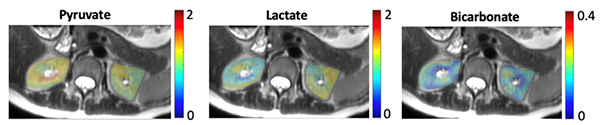 MRI with hyperpolarized 13C-pyruvate can non-invasively image pyruvate metabolism to lactate via lactate deyhydrogenase and bicarbonate as pyruvate enters the Krebs cycle via pyruvate dehydrogenase. This example shows metabolism in the kidneys of a healthy human subject. This example shows metabolism in the kidneys of a healthy human subject.