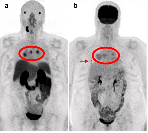 Figure: Ga-68 PSMA PET (a) and F-18 FDG PET (b) of the same patient with poorly differentiated papillary thyroid cancer. The patient's metastatic disease in the chest (red ovals) had more PSMA uptake than FDG uptake. Interestingly, however, a small right-sided rib metastasis (b, arrow) was only seen on FDG PET, suggesting a component of intra-patient heterogeneity.