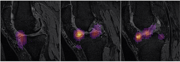 Occlusion maps used to identify imaging biomarkers associated with future TKR incidence. Meniscus and Ligaments are observed as significant locations
