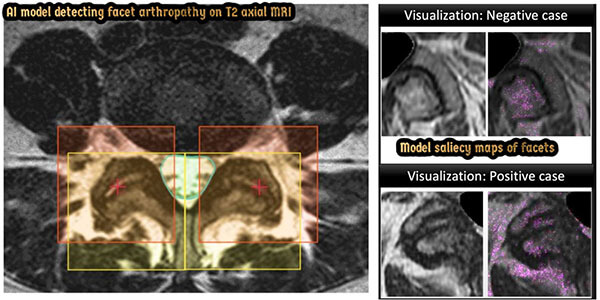 An AI model we developed to detect lumbar facet arthropathy. An AI model we developed to detect lumbar facet arthropathy.