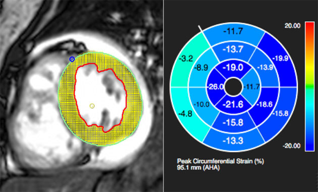 Quantification of regional myocardial strain - Kimberly Kallianos, MD