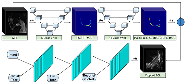 Segmentation of a knee MRI with two V-Nets and subsequent classification with hierarchical convolutional neural networks to detect reconstructed, fully torn, partially torn, and intact ACLs